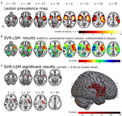 Associations of lesion location, structural disconnection, and functional diaschisis with depressive symptoms post stroke